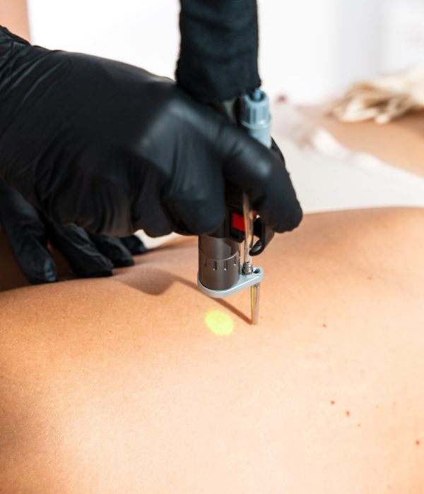 Epilazione laser permanente Bari