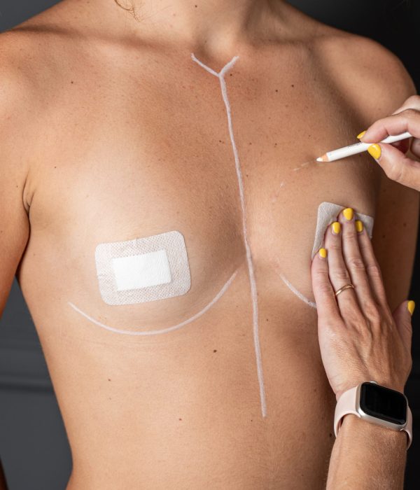 Mastoplastica Additiva